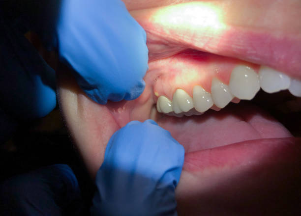 Best Emergency Gum Treatment in Beaumont, CA