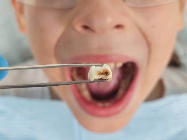 Best Urgent Care for Lost Fillings or Crowns in Beaumont, CA