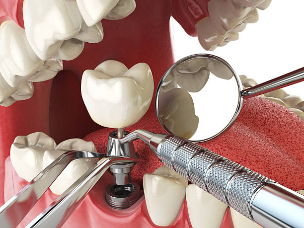 Best Emergency Tooth Extraction in Beaumont, CA